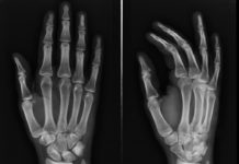 “Dripping Candle Wax” Bone Disease Genetic Cause Uncovered