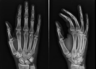 “Dripping Candle Wax” Bone Disease Genetic Cause Uncovered