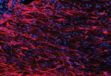 Brain Iron Accumulation Linked Huntington’s Disease Brain Iron Accumulation Linked Huntington’s Disease