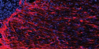 Brain Iron Accumulation Linked Huntington’s Disease