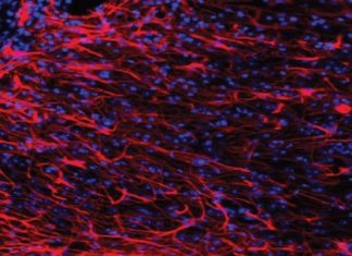 Brain Iron Accumulation Linked Huntington’s Disease Brain Iron Accumulation Linked Huntington’s Disease