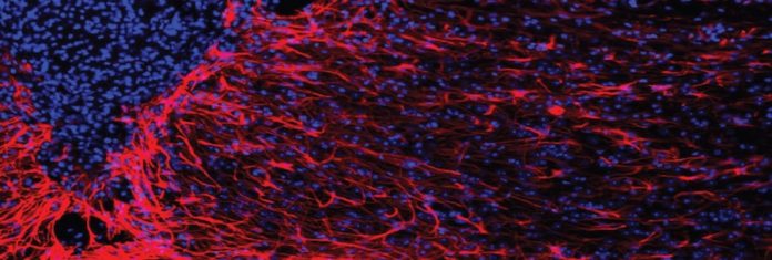 Brain Iron Accumulation Linked Huntington’s Disease