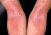 Skin’s Beneficial Bacteria Found to Help Alleviate Severity of Eczema Skin’s Beneficial Bacteria Found to Help Alleviate Severity of Eczema