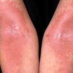 Skin’s Beneficial Bacteria Found to Help Alleviate Severity of Eczema
