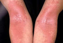 Skin’s Beneficial Bacteria Found to Help Alleviate Severity of Eczema Skin’s Beneficial Bacteria Found to Help Alleviate Severity of Eczema