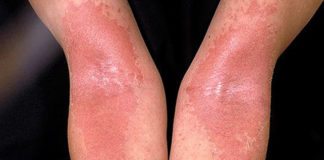 Skin’s Beneficial Bacteria Found to Help Alleviate Severity of Eczema