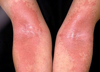 Skin’s Beneficial Bacteria Found to Help Alleviate Severity of Eczema Skin’s Beneficial Bacteria Found to Help Alleviate Severity of Eczema