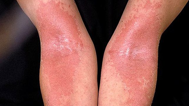 Skin’s Beneficial Bacteria Found to Help Alleviate Severity of Eczema