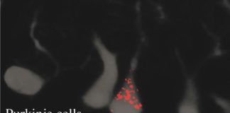 Study Identifies Gene That Reigns in Neurons, Can Prevent Protein Aggregates