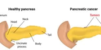 Targovax’s Neo-Antigen Immunotherapy for Pancreatic Cancer Shows Promise in Phase I/II 