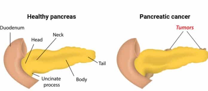 Targovax’s Neo-Antigen Immunotherapy for Pancreatic Cancer Shows Promise in Phase I/II 