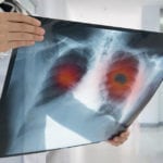 A New Type of Lung Cancer Identified - Latest Update