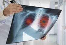 A New Type of Lung Cancer Identified A New Type of Lung Cancer Identified - Latest Update
