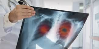 A New Type of Lung Cancer Identified - Latest Update