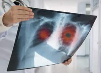 A New Type of Lung Cancer Identified A New Type of Lung Cancer Identified - Latest Update