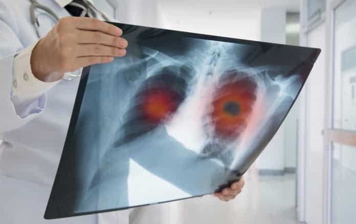 A New Type of Lung Cancer Identified - Latest Update