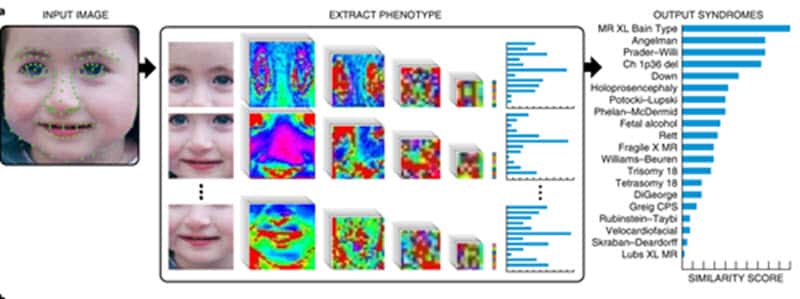 AI Powered Face Scanning App For Detecting Rare Genetic Disorders