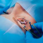 First Human Trial For Stem Cell Based AMD Therapy By NIH