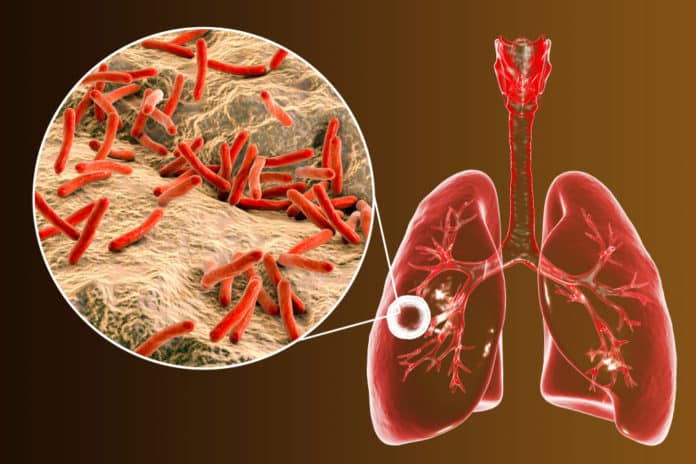 Indian Researchers Discover Potential Drugs Against Tuberculosis