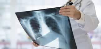 Effective Drug Combinations To Treat Tuberculosis Discovered