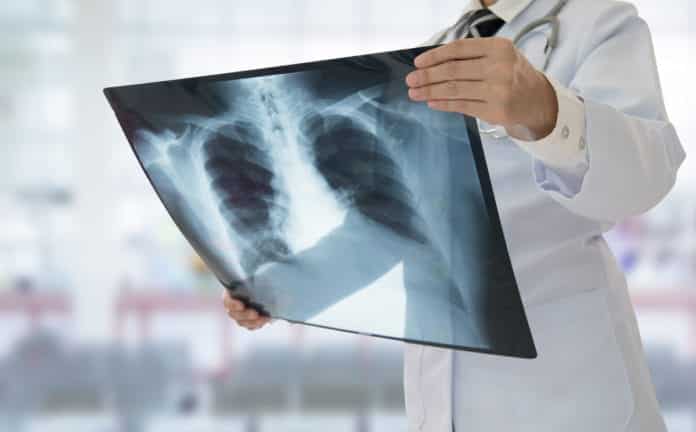Effective Drug Combinations To Treat Tuberculosis Discovered