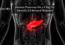 Human Pancreas On a Chip To Identify CF-Related Diabetes Human Pancreas On a Chip To Identify CF-Related Diabetes