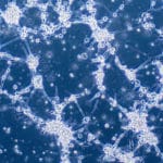 Blood Test For Glioblastoma