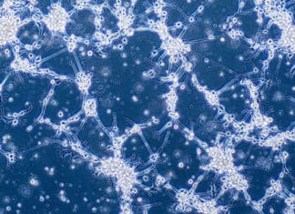 A Simple Blood Test Could Help Diagnose Glioblastoma in Future! Blood Test For Glioblastoma