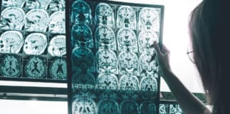 New Drug for Alzheimer's Disease