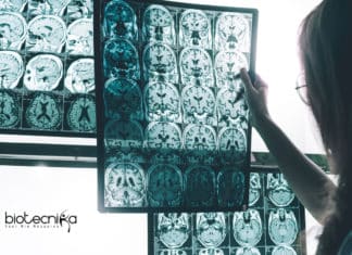 Scientists Discover New Drug For Alzheimer’s Disease New Drug for Alzheimer's Disease