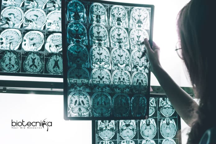 New Drug for Alzheimer's Disease