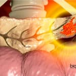 Pancreatitis Clinical Mystery Solved