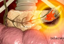 Gene Discovery Solves 51 Year Old Pancreatitis Clinical Mystery Pancreatitis Clinical Mystery Solved