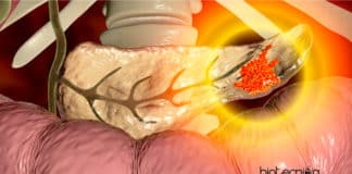 Pancreatitis Clinical Mystery Solved