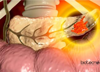 Gene Discovery Solves 51 Year Old Pancreatitis Clinical Mystery Pancreatitis Clinical Mystery Solved