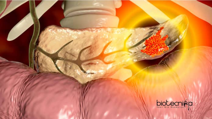 Pancreatitis Clinical Mystery Solved