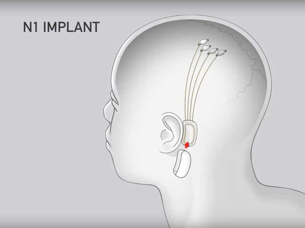 Neuralink AI brain chips