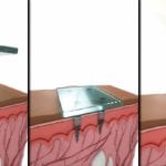 Medical Information Below Skin