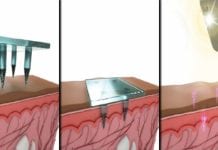 MIT Scientists Develops A Method To Store Medical Information Below The Skin Medical Information Below Skin