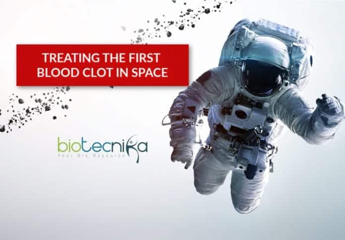 the first blood clot in space treated