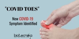 Covid toes as symptom of coronavirus