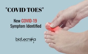 Covid toes as symptom of coronavirus