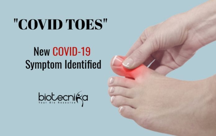 Covid toes as symptom of coronavirus