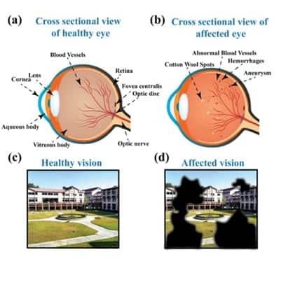 Device to detect diabetic retinopathy