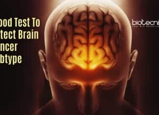 Highly Sensitive Non Invasive Blood Test To Determine Brain Cancer Subtype blood test for brain tumors
