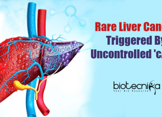 Uncontrolled Production Of cAMP Causes Liver Cancer : UC San Diego Research Rare Liver Cancer Triggered