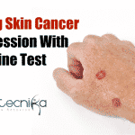 Tracking skin cancer with urine