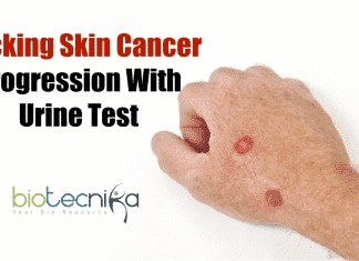 Tracking skin cancer with urine