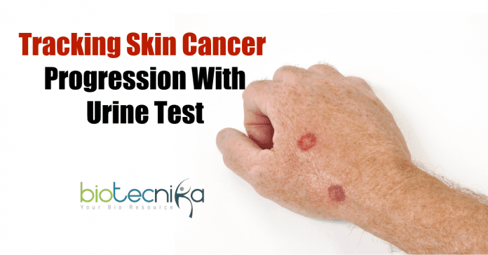 Tracking skin cancer with urine