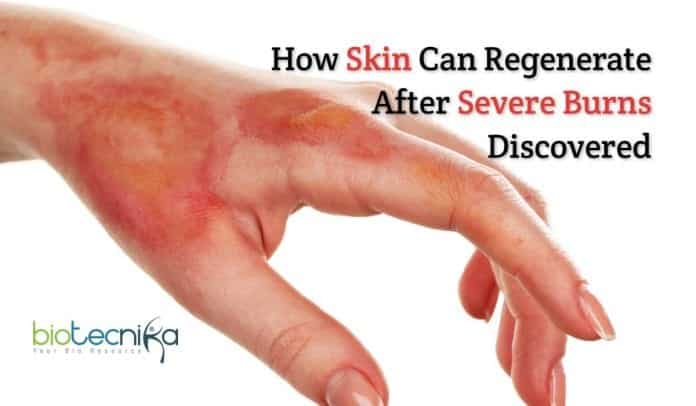 How skin regenerate after severe burns